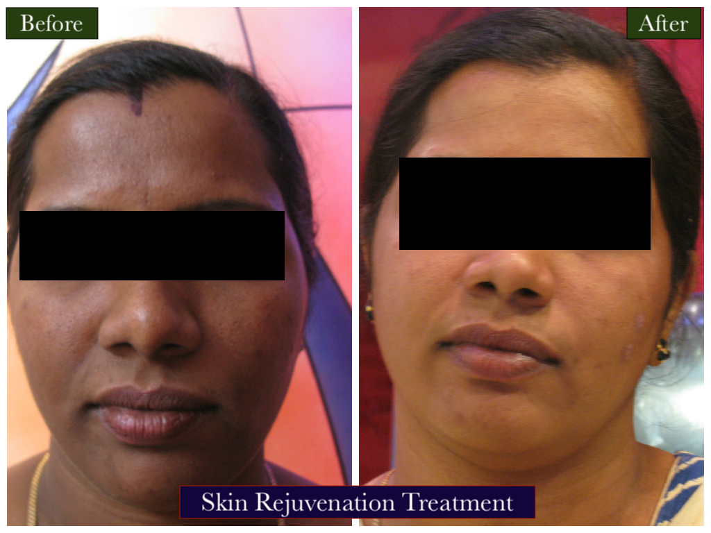 Skin Rejuvenation Treatment